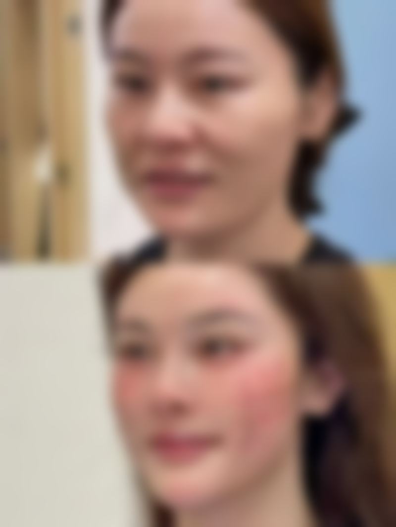 种植头发能维持几年？