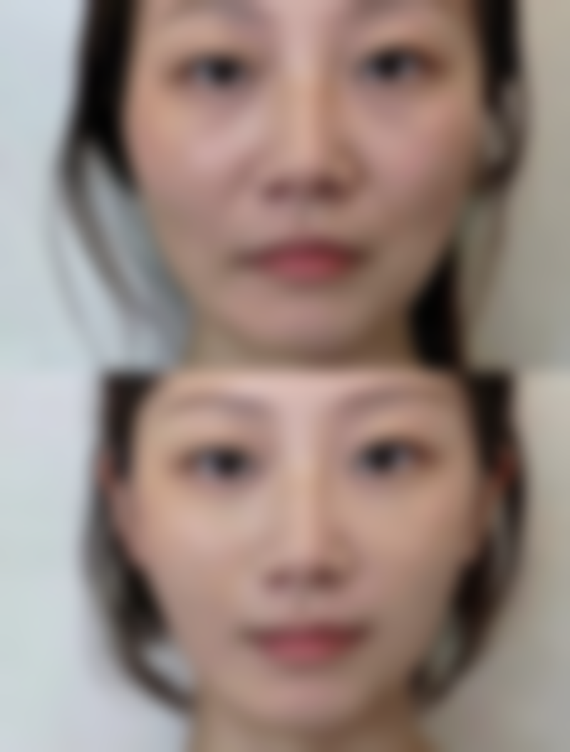 双下巴是打瘦脸针还是溶脂针？