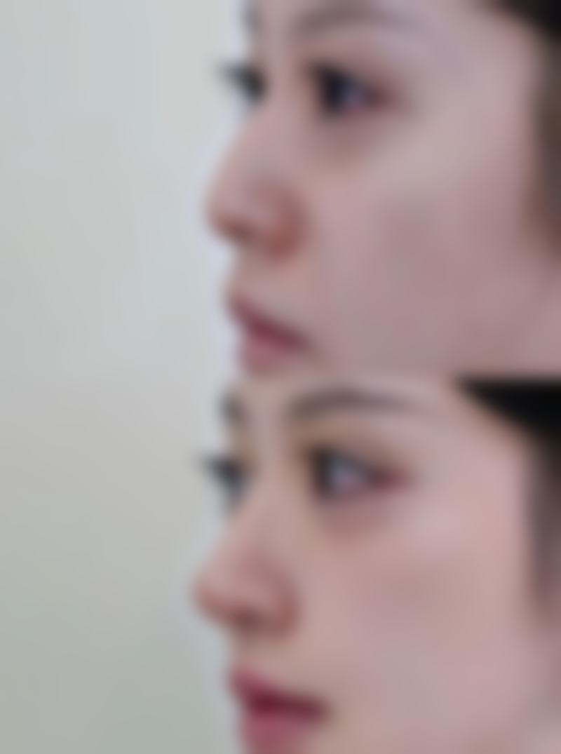 打瘦脸针啥时候可以化妆