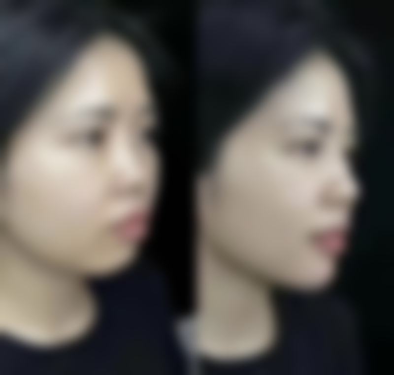 瘦脸针注射管用吗