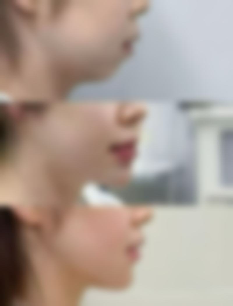 打美白针的副作用危害