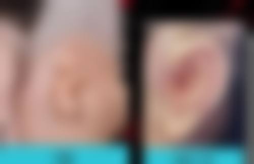 怀孕瘦脸针怎么办？了解3大应对策略，保障母婴健康，解锁安全有效的医美补救方法！ 