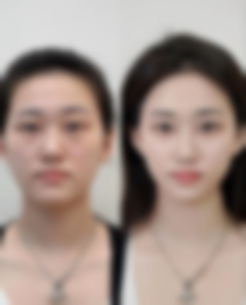 杭州悦可医疗美容诊所高寿松做乳房整形成效如何