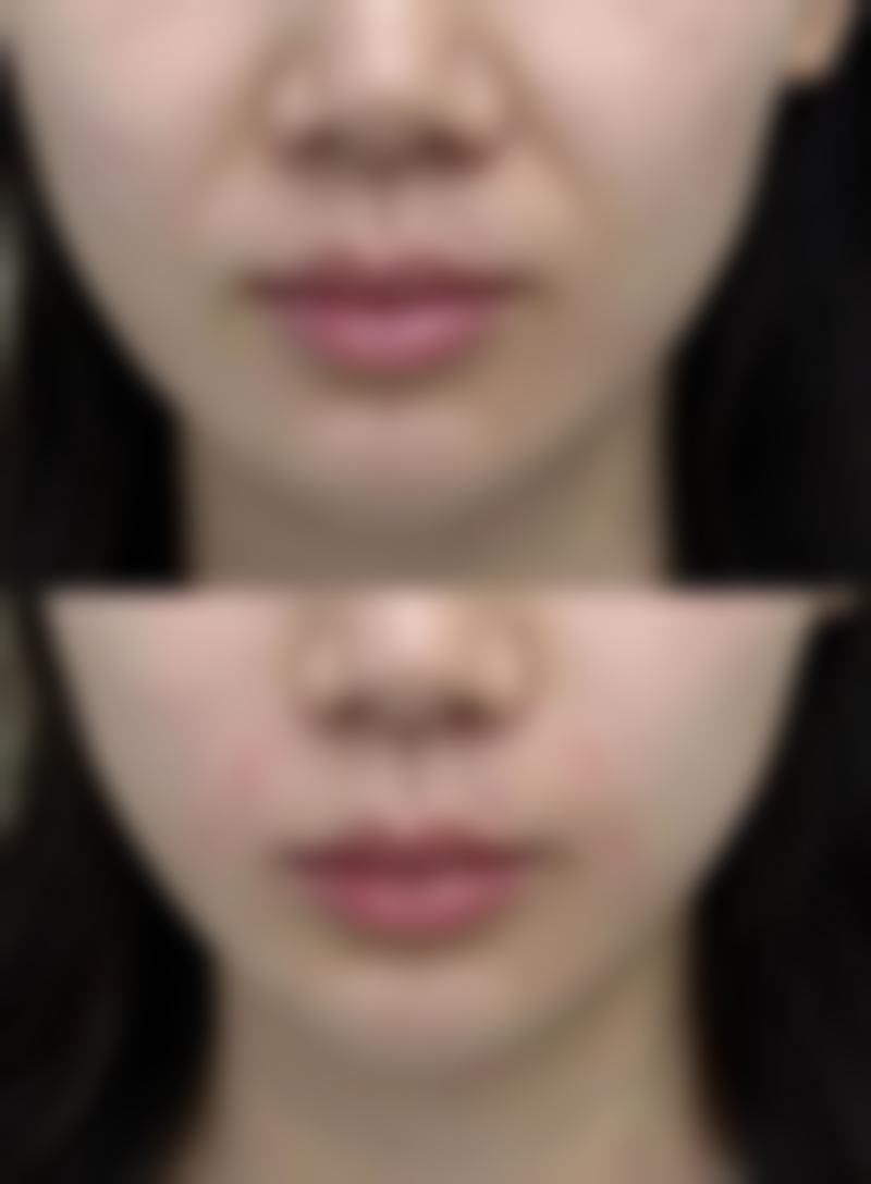瘦脸针能维持多久