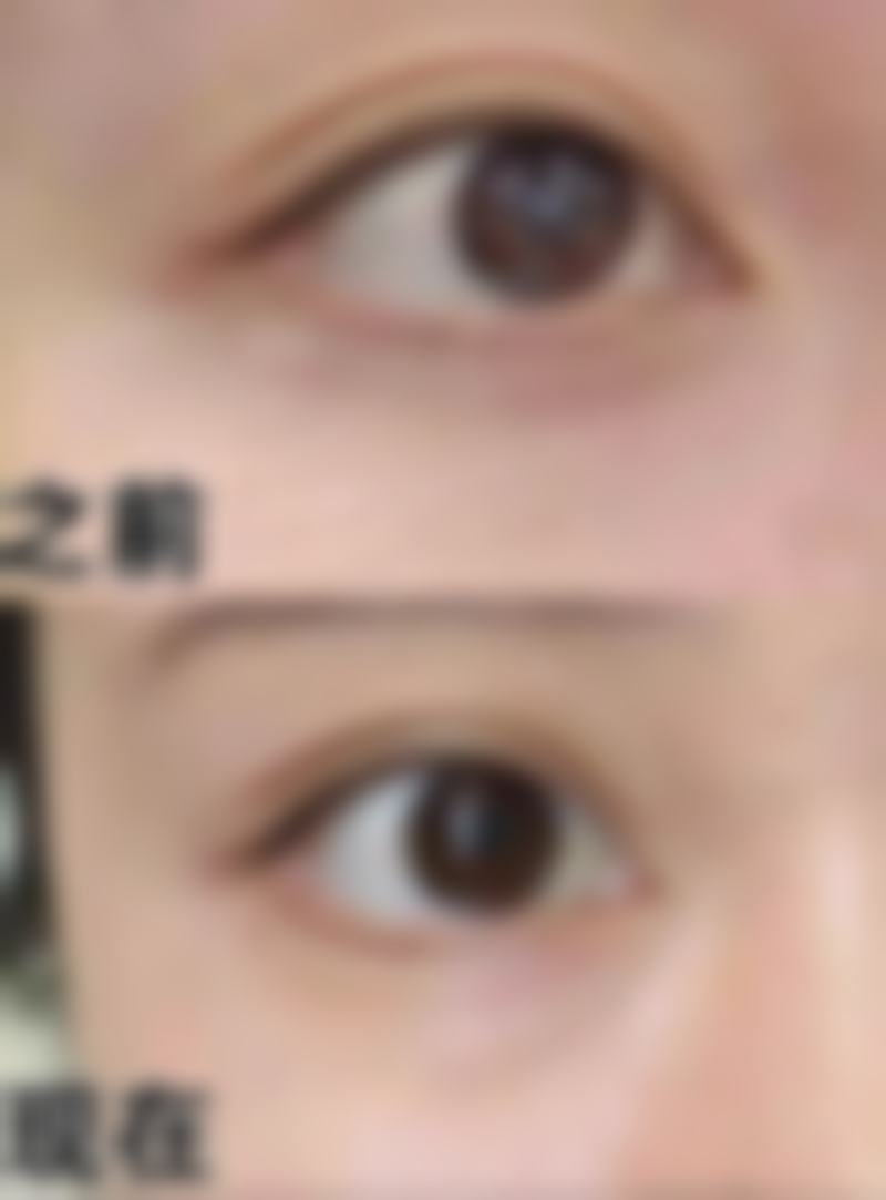 兔唇整形手术价格