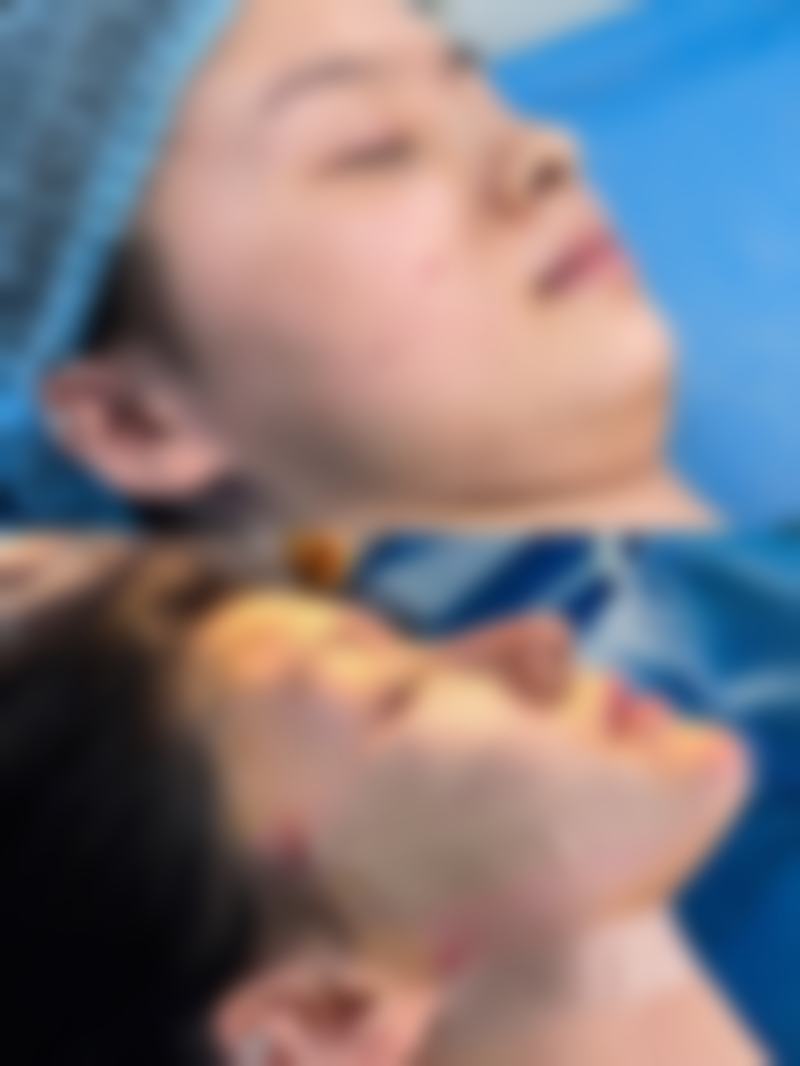 瘦脸针一般打 50 单位还是 100 单位