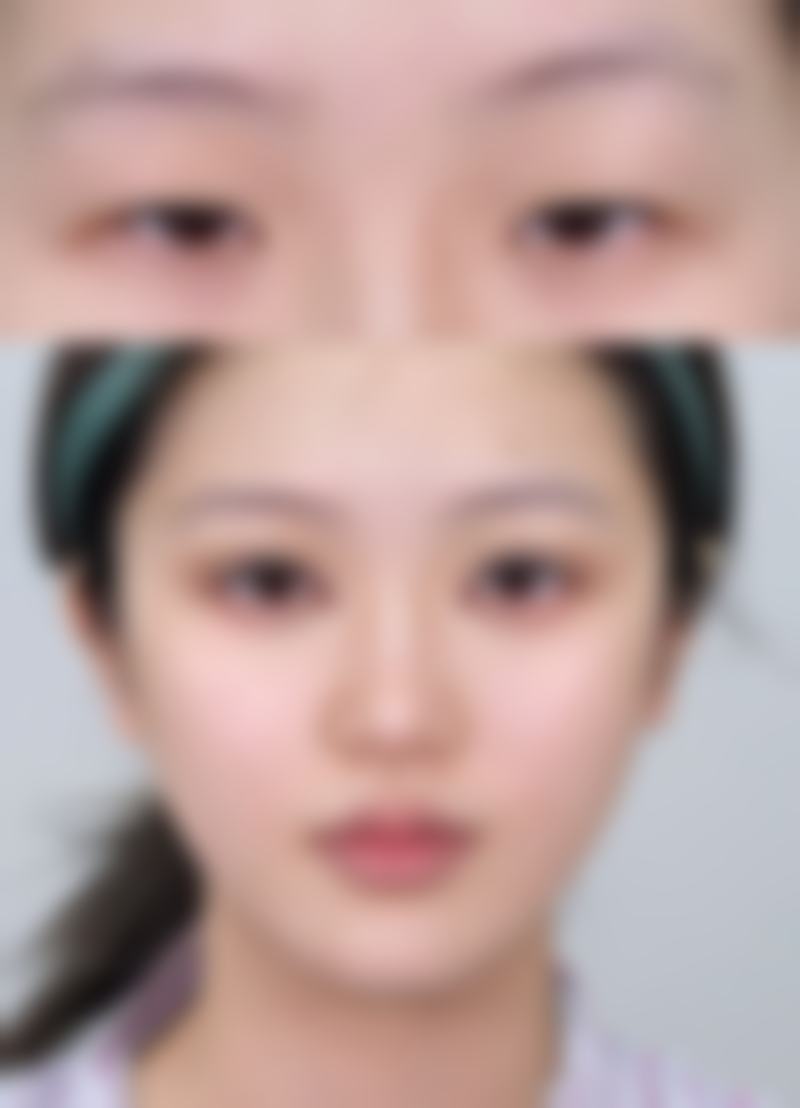 瘦脸针15天有什么变化？揭秘15天内脸型显著变小、线条更流畅，肌肤紧致有弹性的惊人改变！ 
