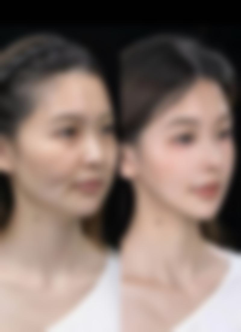 除皱多少钱一次