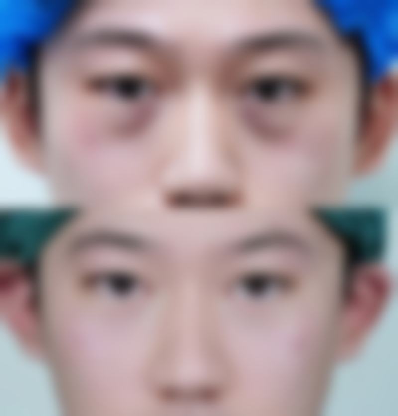 打瘦脸针需要注意什么