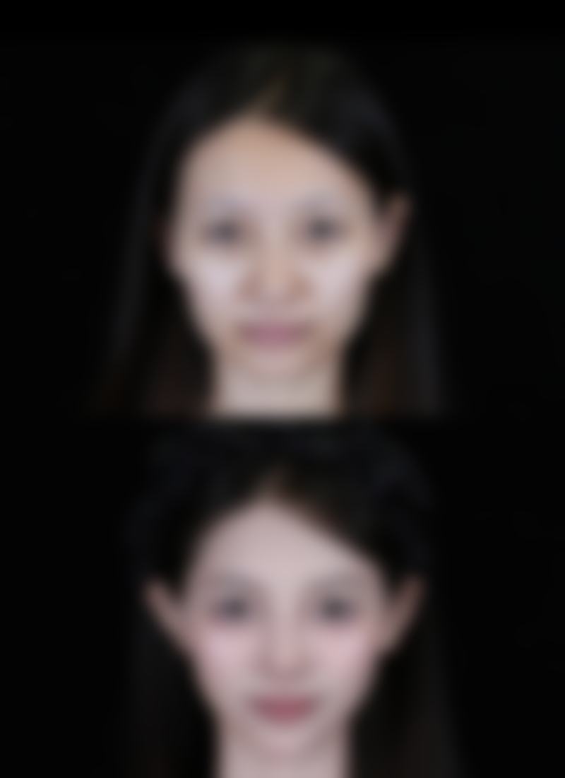瘦脸针多久能怀孕