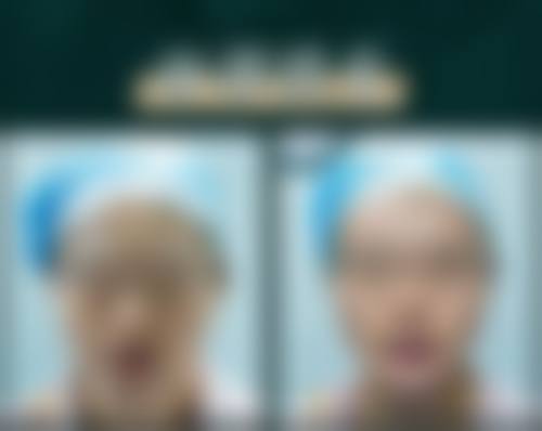广州高尚医学美容中 心梁衍炜做唇裂手术靠谱吗