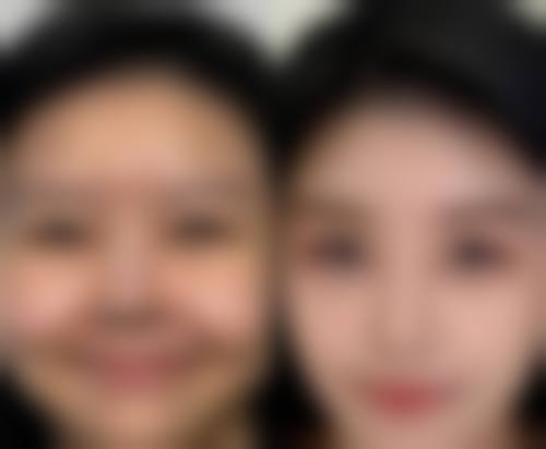 包茎过长矫正方法