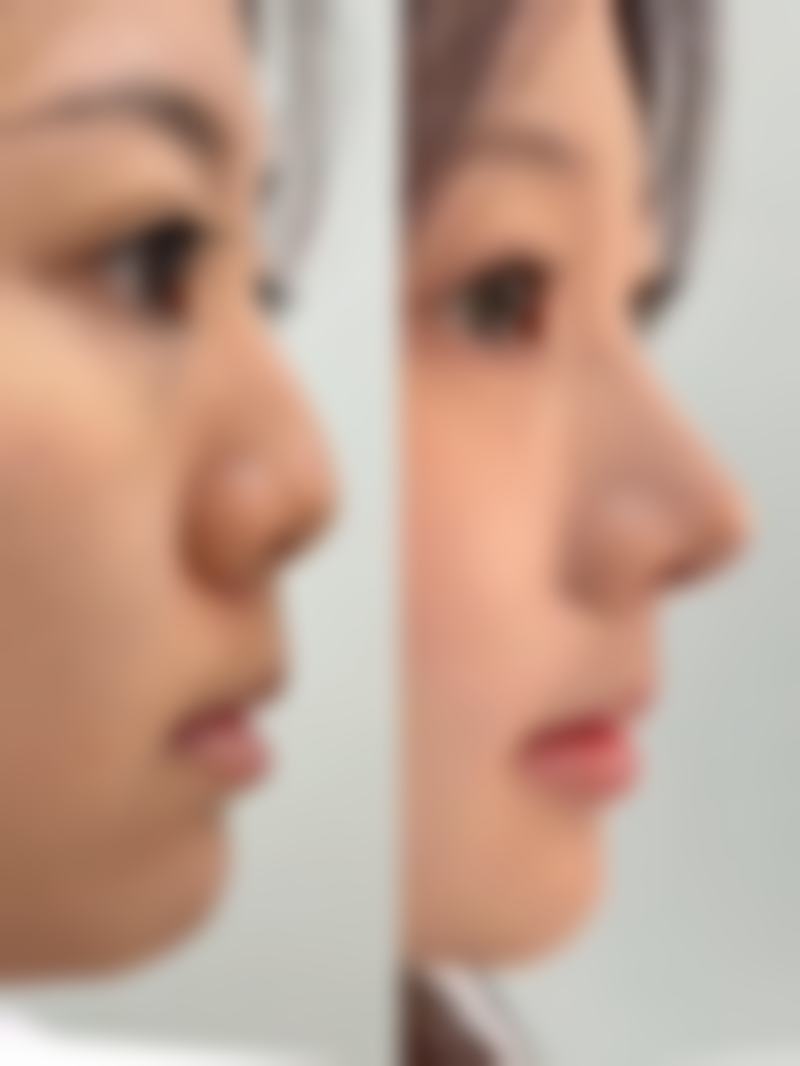 西安未央容好整形医院提供的特色项目十分丰富。有面部整形,比如可以通过手术让面部轮廓更加精致立体;皮肤护理项目能帮助改善肌肤的状态,让肌肤更加光滑细腻;注射美容可以解决一些面部细纹等问题;眼部整形能够让眼睛变得更加明亮有神;祛斑祛痘针对有肌肤瑕疵的人群;身体塑形可以塑造理想的身材曲线;脂肪填充则可以让面部更加饱满有光泽。