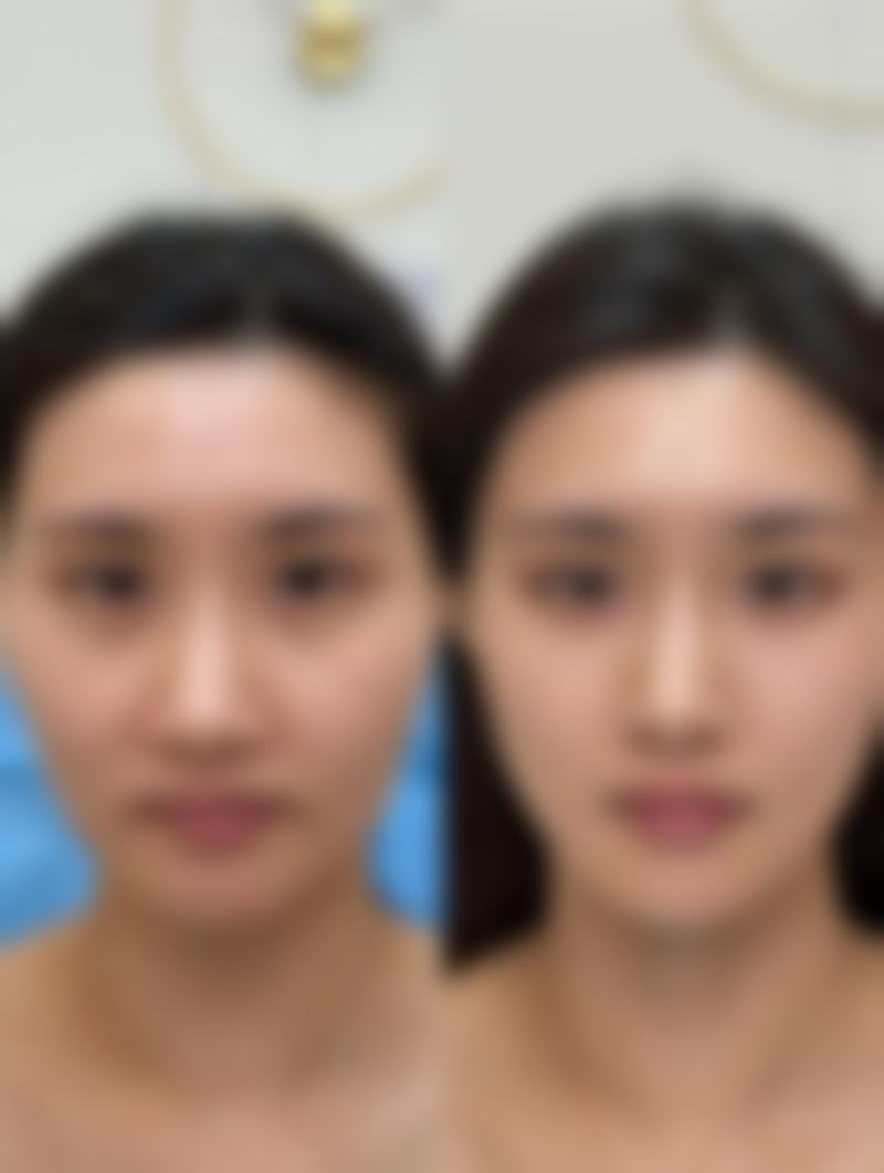 种植头发要休息多久才能修复