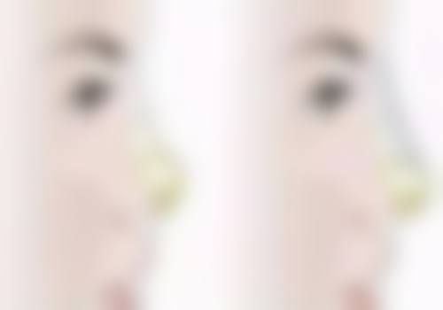 瘦脸针一般打50单位还是100单位