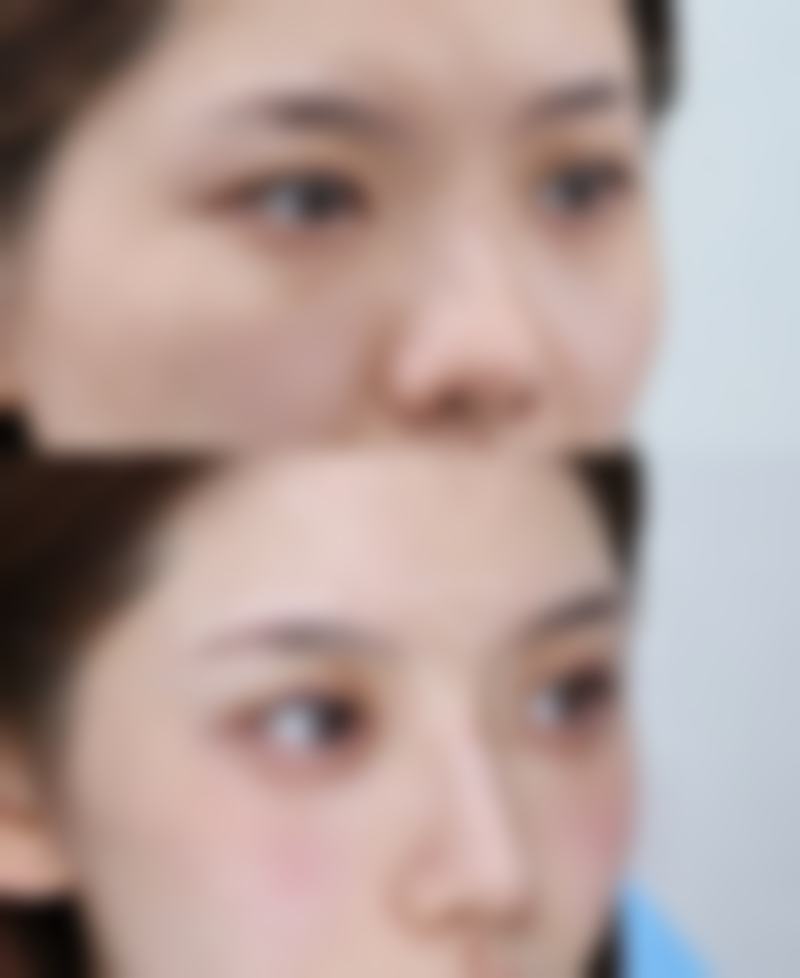 保妥适瘦脸针安心吗