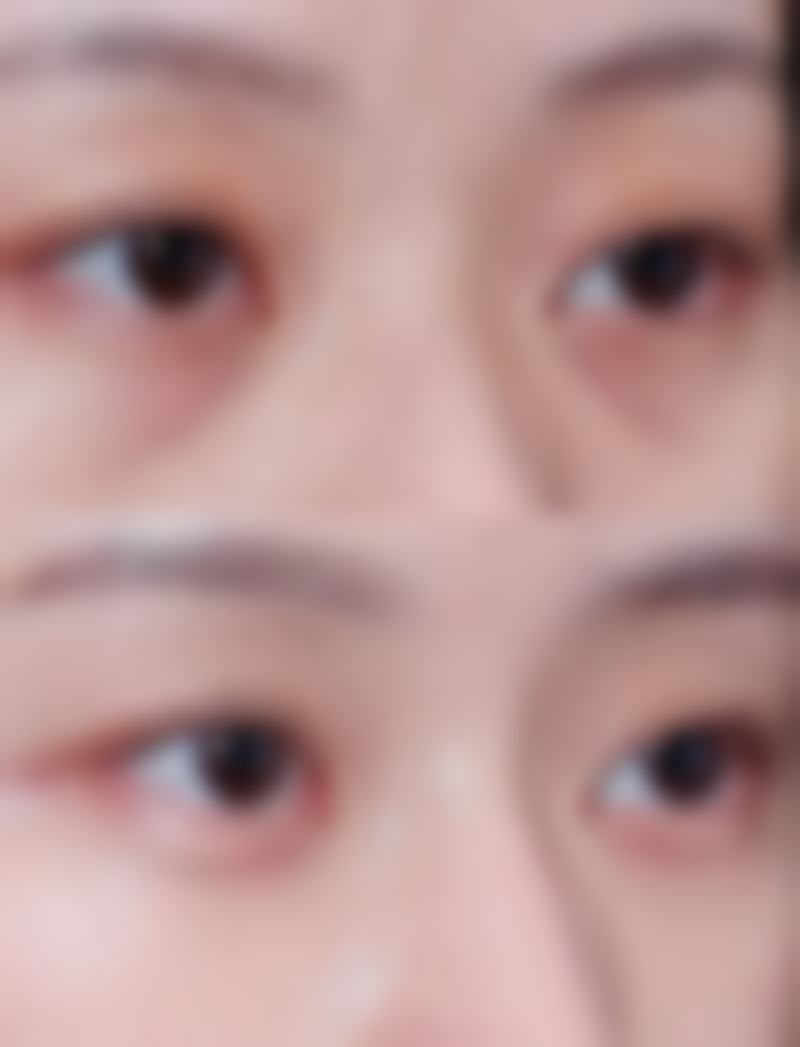 打瘦脸针会垮脸吗