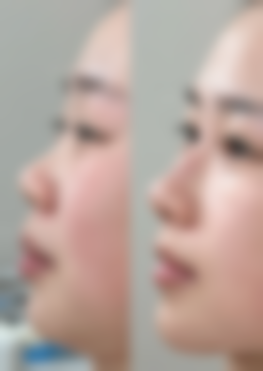打了瘦脸针怎么保持平躺