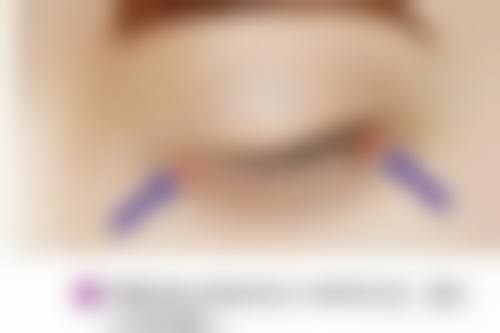白肉瘦脸针