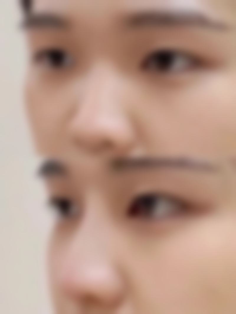 患者2：我做了硅胶假体隆鼻，现在鼻子的形态非常自然，就像天生的一样。门诊部的环境良好，服务也特别周到，从术前的询问到术后的护理，每一个环节都让人特别满意。