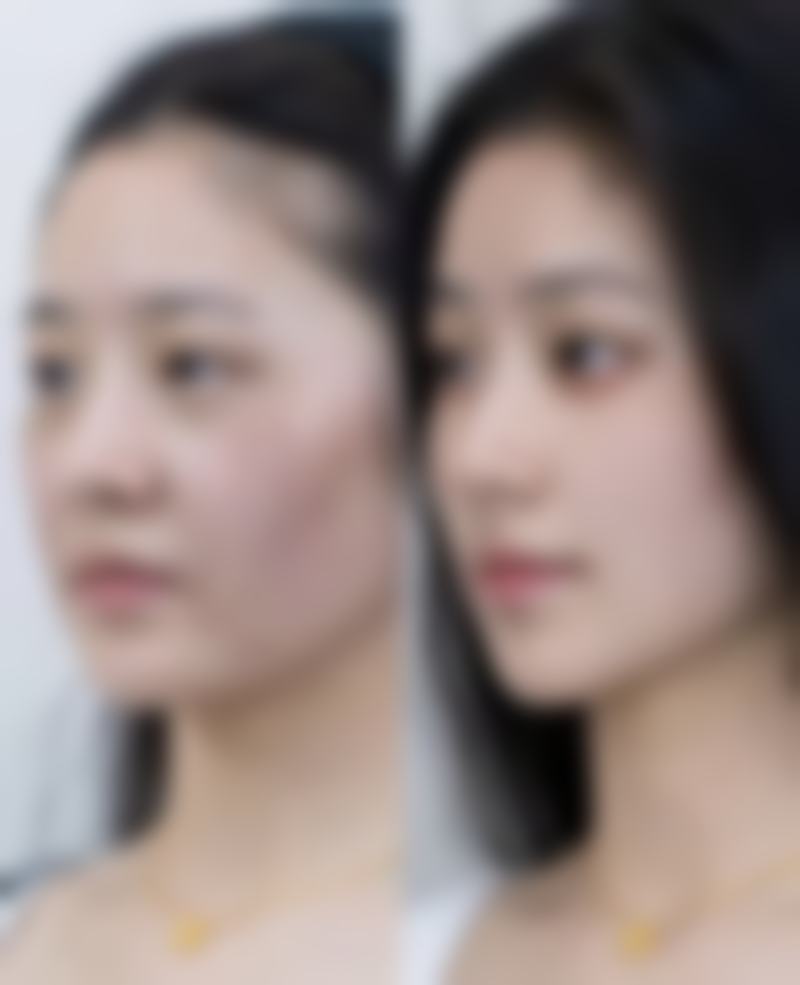 注射瘦脸针的注意事项