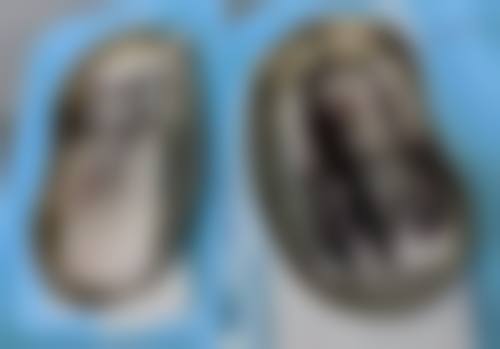 有人打瘦脸针不起作用的吗?探究成效差异原因