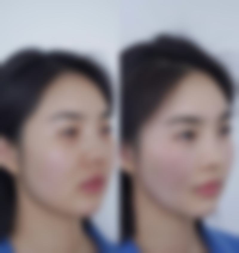 头发种植效果好不好？权威数据揭秘，超 90% 发友术后满意度高，新生浓密秀发不是梦！ 