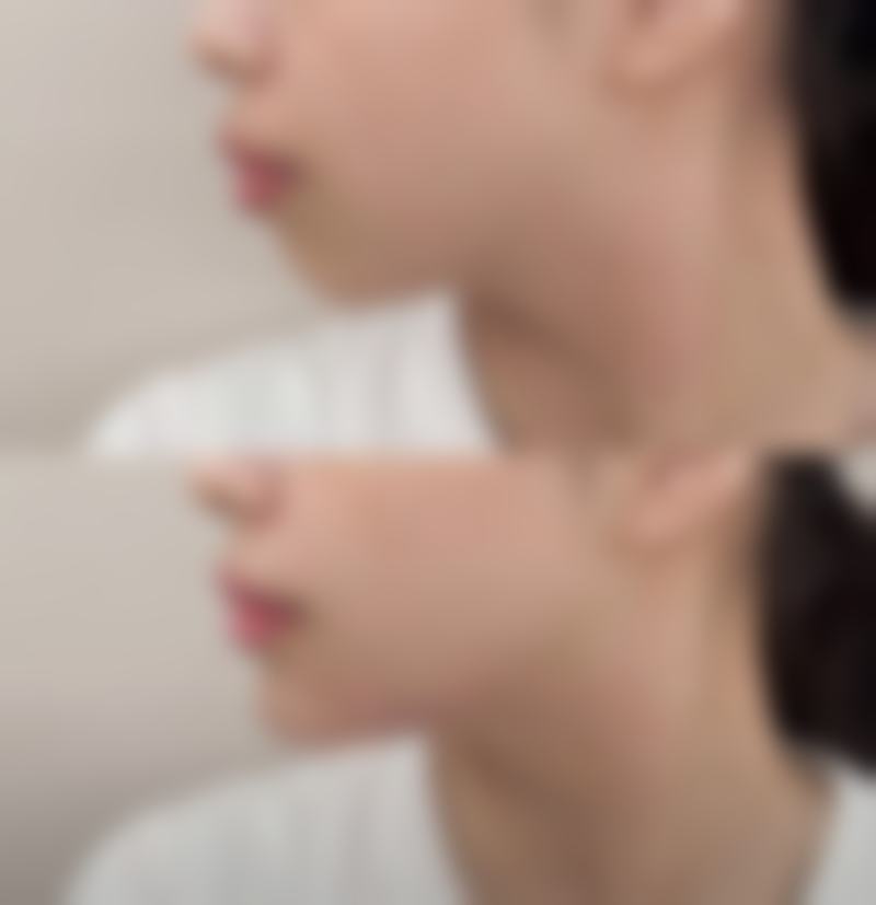 打完瘦脸针多久可以平躺