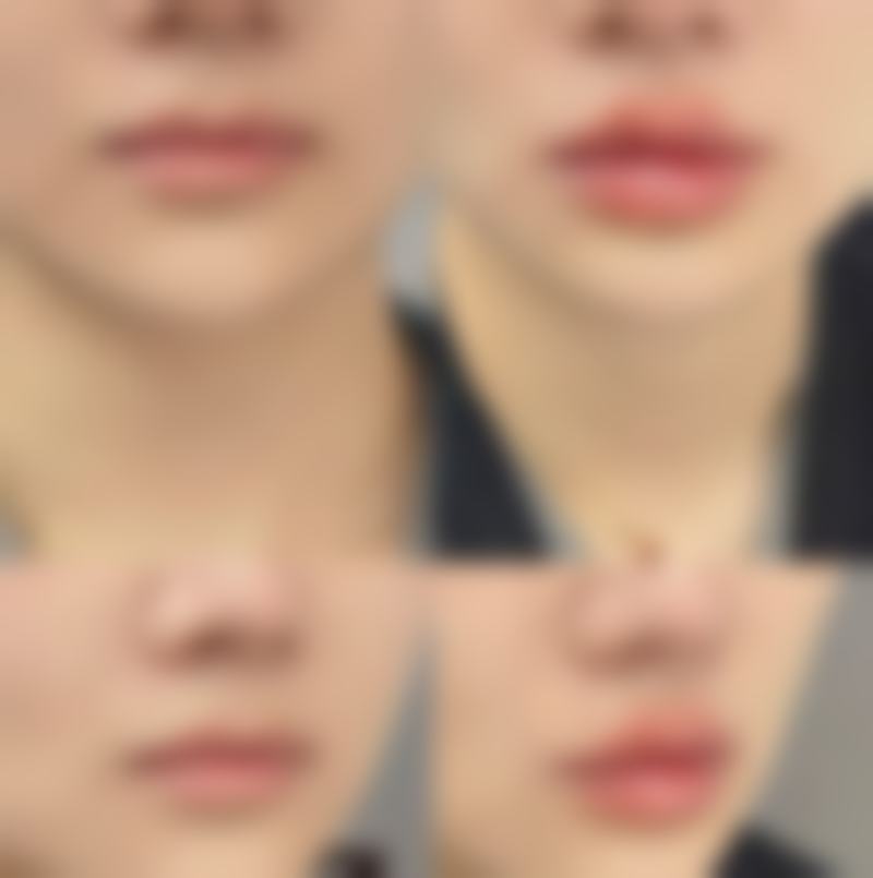 打完瘦脸针正确的睡姿