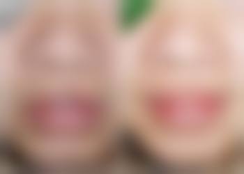 瘦脸针会让脸颊凹陷吗
