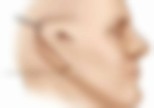 瘦脸针会扩散吗?
