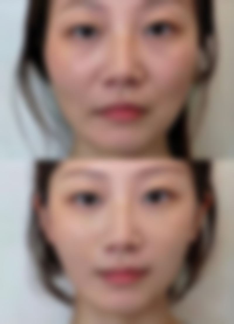 嘴巴整形怎么做的视频
