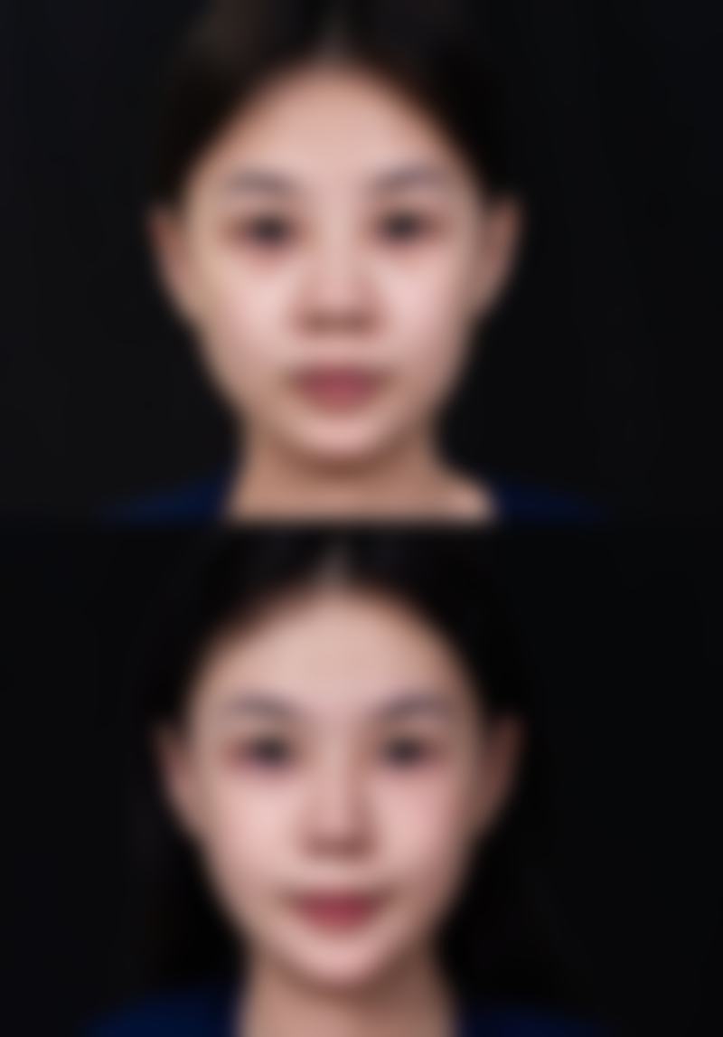 溶脂针和瘦脸针哪个成效好点
