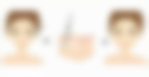 瘦脸针打一次维持多久