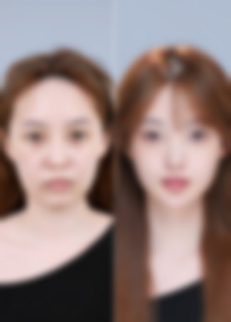 黄褐斑脸上打针能治好吗