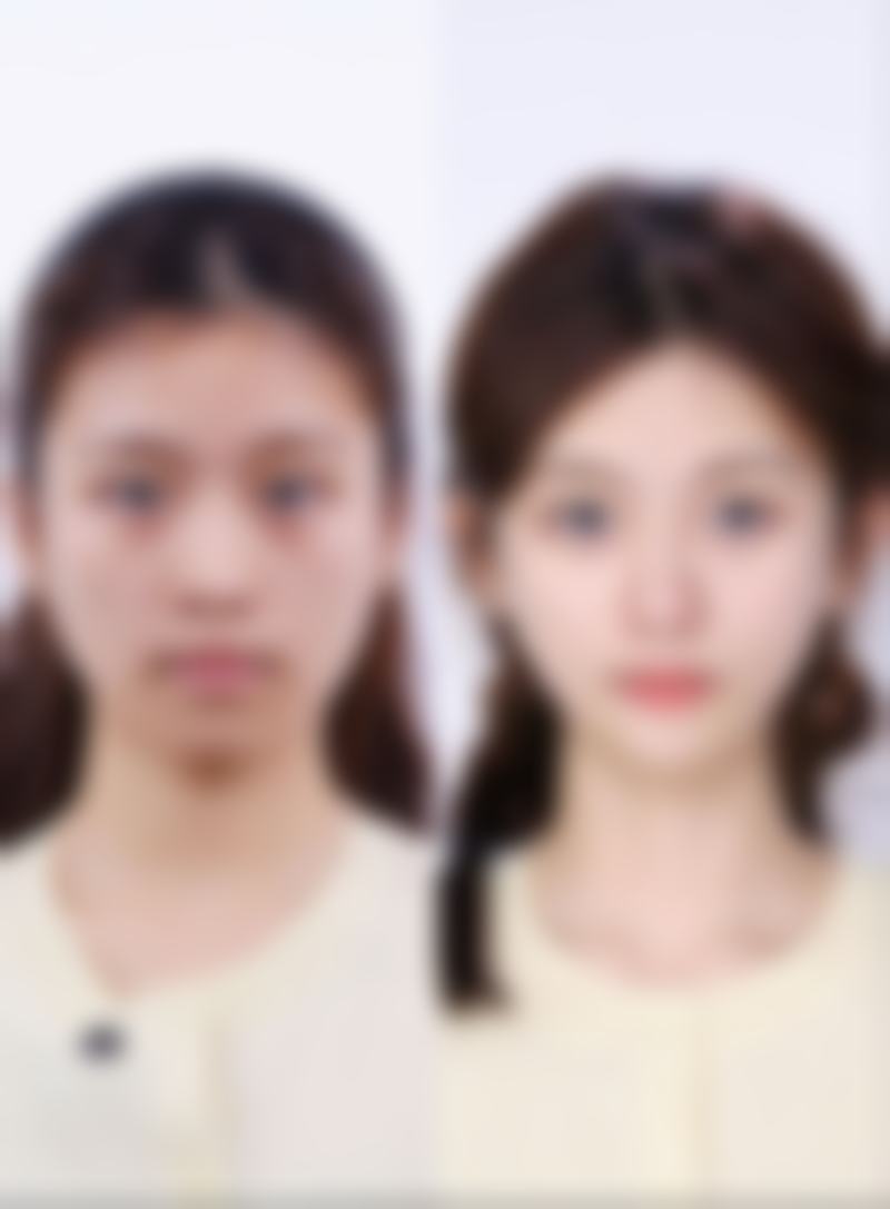 影响四十岁女性打瘦脸针的因素
