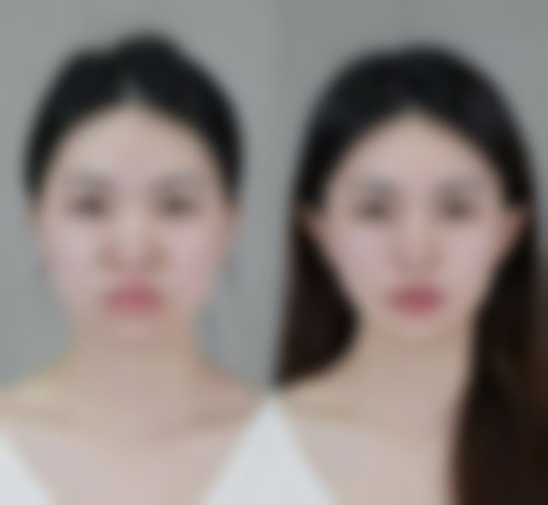 瘦脸针第九天了怎么还没见效？别慌！了解这5个关键因素，助你快速看到瘦脸神奇效果！ 