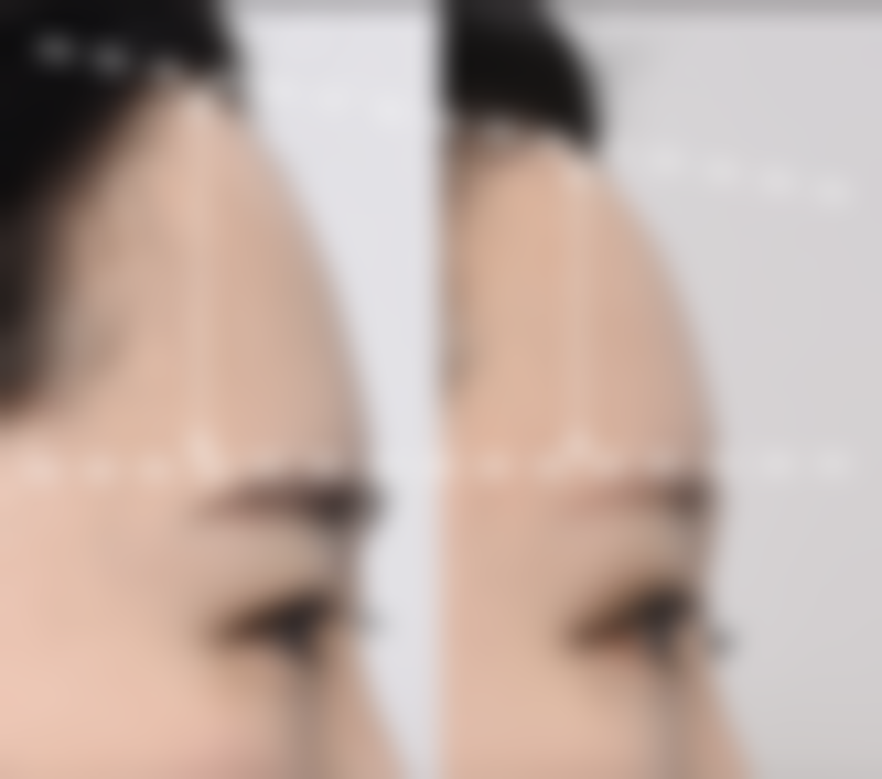 除皱一般保持多久