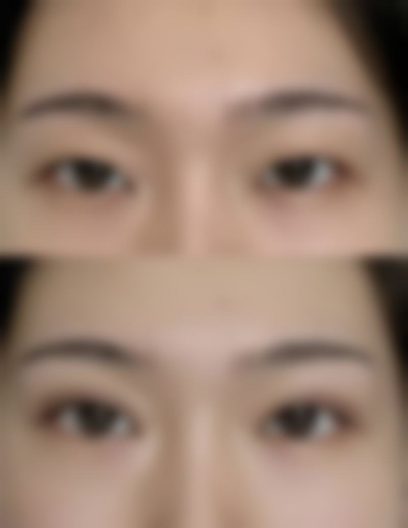 除皱能维持多久时间有成效