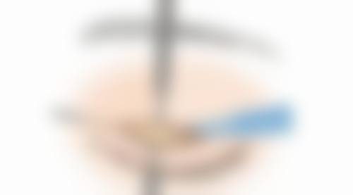 瘦脸针打到咬肌旁边了有瘦脸成效吗
