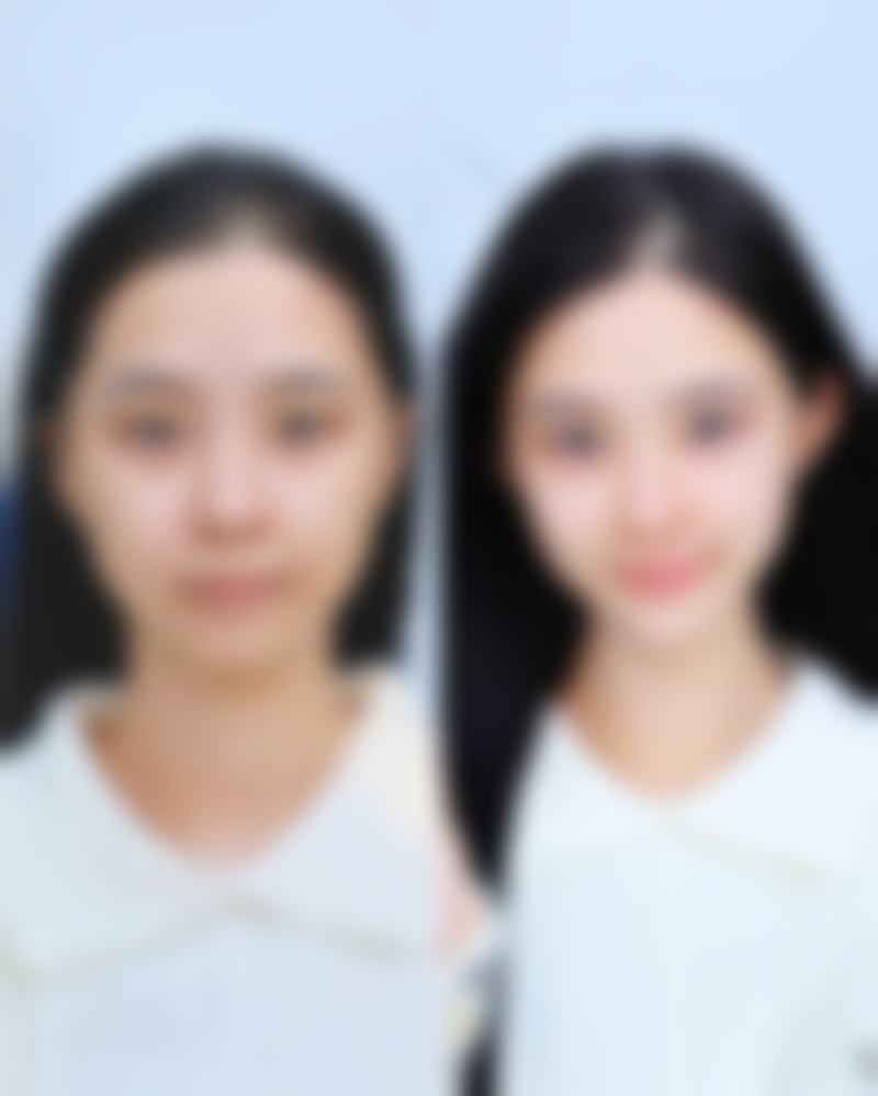种植发际线毛囊多久成活