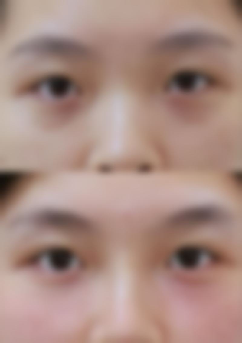 瘦脸针一般打50单位还是100单位