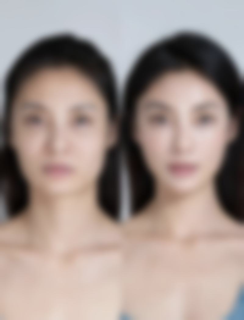 打完瘦脸针脸颊凹陷能修复到以前的样子吗