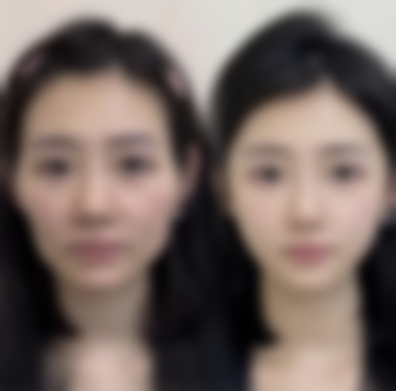 瘦脸针打一次维持多久