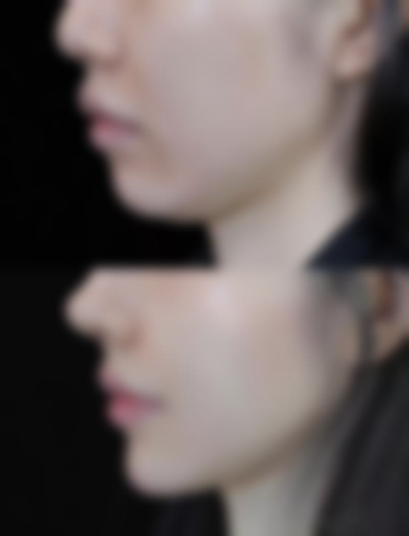 种植毛发后的成效图