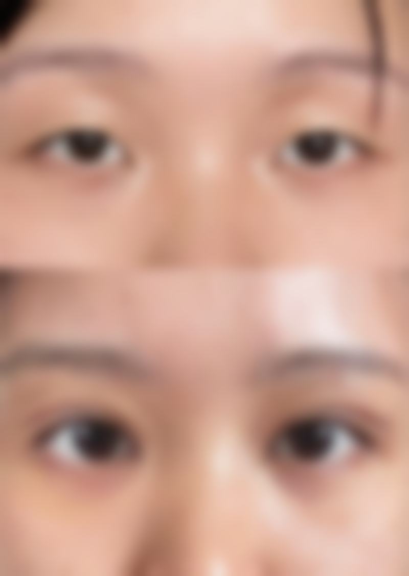 脂肪填充胸部可以维持多久时间