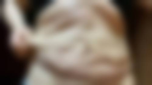 头上有疤能种植头发吗？权威解答：植发成功率高达 90%，3 大优势让你重拾浓密秀发！ 