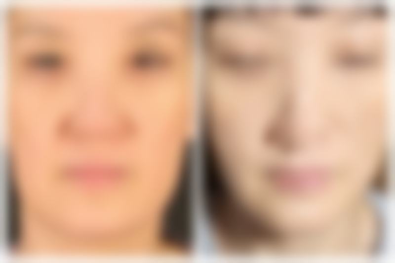 种植发际线成活率高吗?