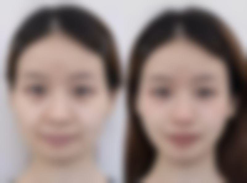 瘦脸针多少钱打一针