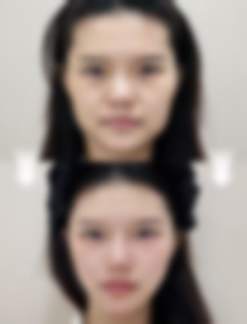 打完除皱几天可以化妆洗脸